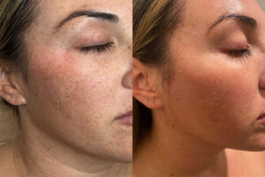 Morpheus IPL - Before and After